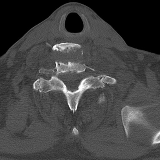 File:Bilateral C6-7 locked facet dislocation (Radiopaedia 28506-28748 Axial bone window 29).jpeg