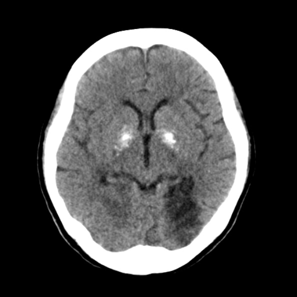 File:Bilateral PCA territory infarction - different ages (Radiopaedia 46200-50591 Axial non-contrast 10).jpg
