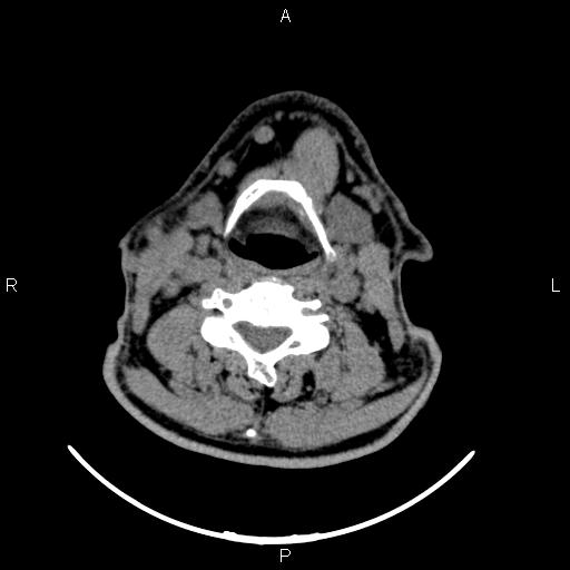 Bilateral Warthin tumors (Radiopaedia 84034-99263 Axial non-contrast 36).jpg