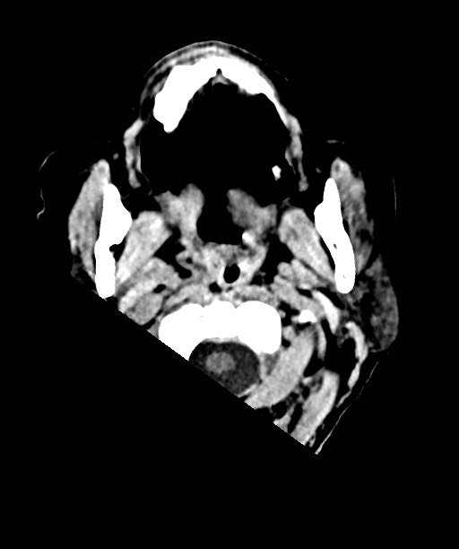 Bilateral acute on chronic subdural hematomas (Radiopaedia 78466-91146 Axial non-contrast 3).jpg