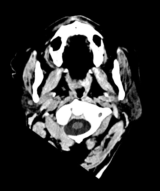 Bilateral acute on chronic subdural hematomas (Radiopaedia 78466-91146 Axial non-contrast 5).jpg