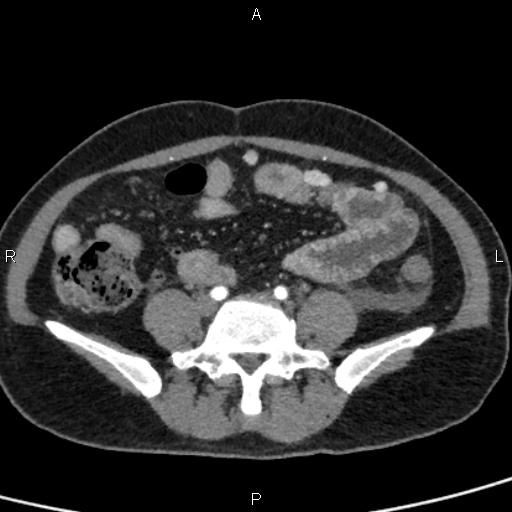 Bilateral adrenal gland hyperenhancement in pancreatitis (Radiopaedia 86642-102753 B 91).jpg