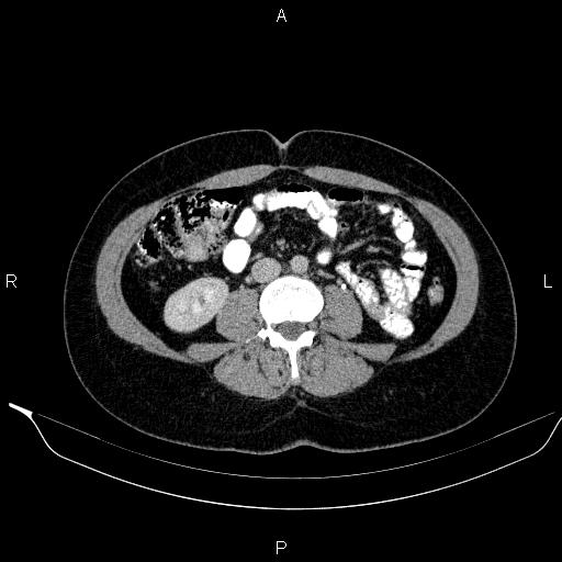 Bilateral adrenal myelolipoma (Radiopaedia 63058-71535 Axial C+ delayed 79).jpg