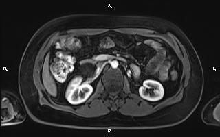 Bilateral adrenal myelolipoma (Radiopaedia 63058-71537 Axial T1 C+ fat sat 49).jpg