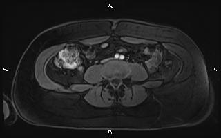 Bilateral adrenal myelolipoma (Radiopaedia 63058-71537 Axial T1 C+ fat sat 72).jpg