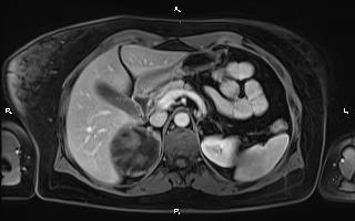 Bilateral adrenal myelolipoma (Radiopaedia 63058-71537 G 34).jpg