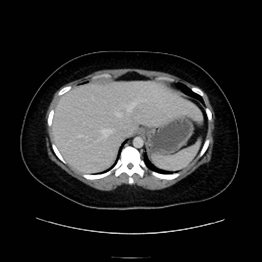 Bilateral adrenal thrombosis (Radiopaedia 58182-65256 A 9).jpg