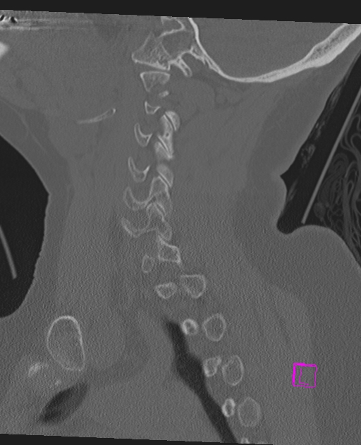 Bilateral atlanto-occipital assimilation (Radiopaedia 28350-28603 Sagittal bone window 26).jpg