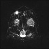Bilateral basal ganglia and thalamic T1 hyperintensities (Radiopaedia 19764-19802 Axial DWI 3).jpg
