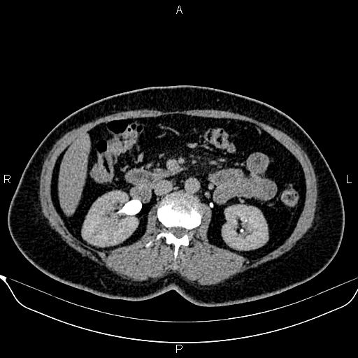 Bilateral benign adrenal adenomas (Radiopaedia 86912-103124 Axial C+ delayed 65).jpg