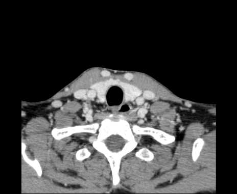 Bilateral carotid body tumors (Radiopaedia 61841-69870 Axial Post contrast 98).jpg
