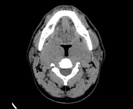 Bilateral carotid body tumors (Radiopaedia 61841-69870 Axial non-contrast 37).jpg