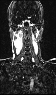 Bilateral carotid body tumors and right glomus jugulare tumor (Radiopaedia 20024-20060 MRA 104).jpg