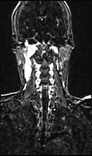 Bilateral carotid body tumors and right glomus jugulare tumor (Radiopaedia 20024-20060 MRA 113).jpg
