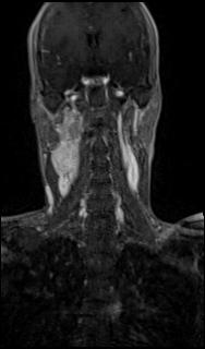 Bilateral carotid body tumors and right glomus jugulare tumor (Radiopaedia 20024-20060 MRA 34).jpg