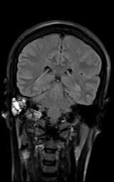 File:Bilateral carotid body tumors and right jugular paraganglioma (Radiopaedia 20024-20060 Coronal 54).jpg