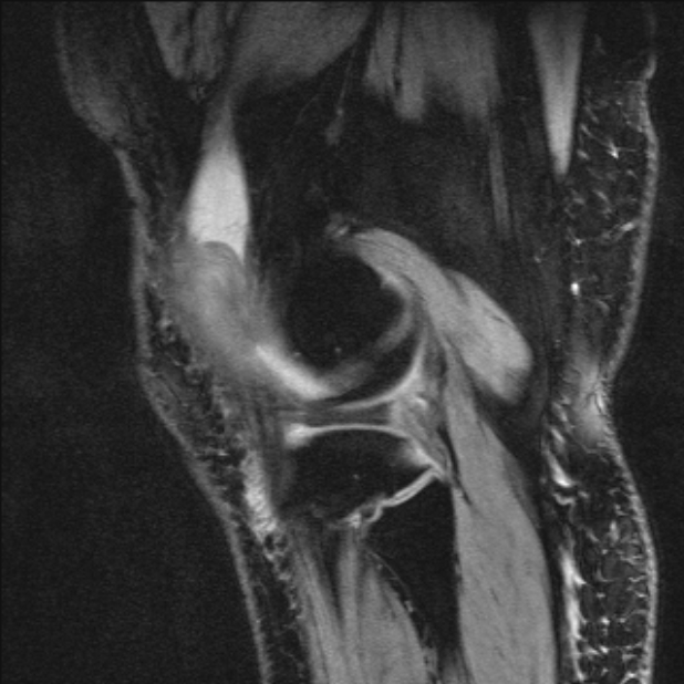 Bilateral focal pigmented villonodular synovitis (Radiopaedia 67643-77046 G 53).jpg