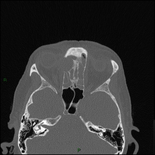 File:Bilateral frontal mucoceles (Radiopaedia 82352-96454 Axial bone window 134).jpg