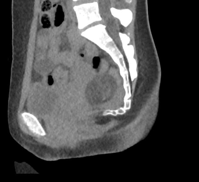 Bilateral mature cystic ovarian teratoma (Radiopaedia 88821-105592 D 34).jpg