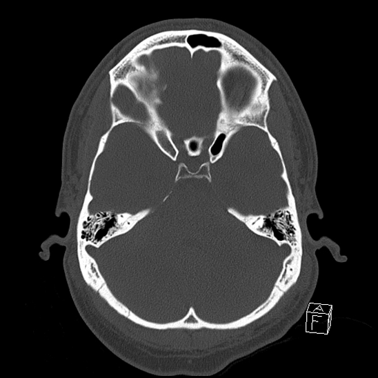 File:Bilateral occipital condyle fracture (type 2) (Radiopaedia 87675-104089 Axial bone window 39).jpg