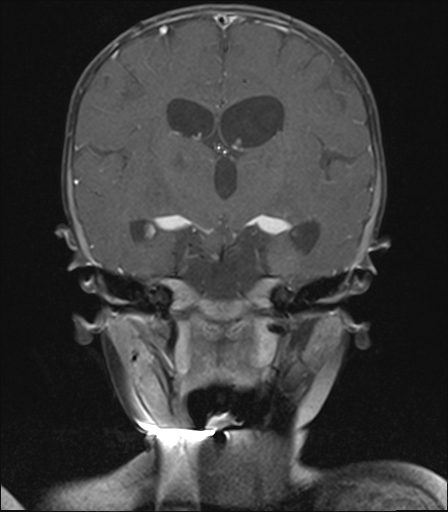 File:Bilateral optic pathway gliomas (Radiopaedia 40013-42514 D 13).jpg