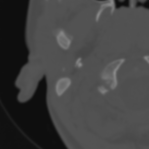 Bilateral otosclerosis (Radiopaedia 57237-64157 B 2).jpg