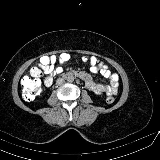 Bilateral ovarian serous cystadenocarcinoma (Radiopaedia 86062-101989 Axial C+ delayed 36).jpg