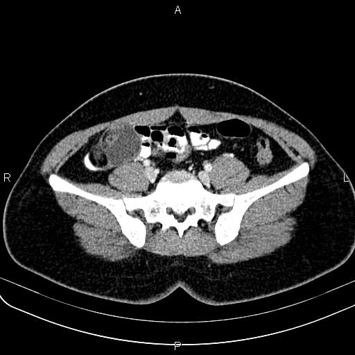 File:Bilateral ovarian teratoma (Radiopaedia 83131-97503 Axial With contrast 19).jpg