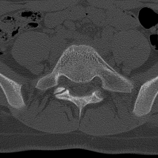 File:Bilateral pars defect (Radiopaedia 26691-26846 Axial bone window 59).jpg