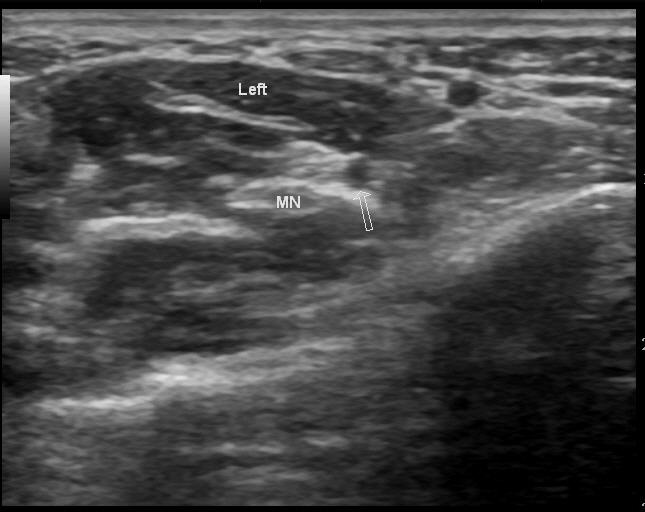File:Bilateral persistent median artery of the forearm with unilateral bifid median nerve (Radiopaedia 17430-17121 A 1).jpg