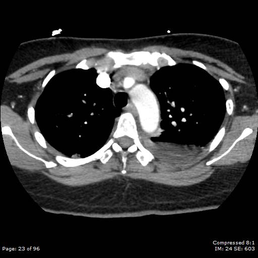 Bilateral pulmonary emboli with Hampton hump sign (Radiopaedia 54070-60246 Axial C+ CTPA 20).jpg