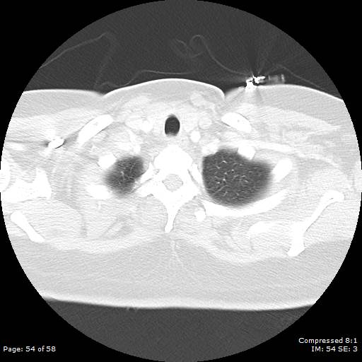 Bilateral pulmonary emboli with Hampton hump sign (Radiopaedia 54070-60246 Axial lung window 54).jpg