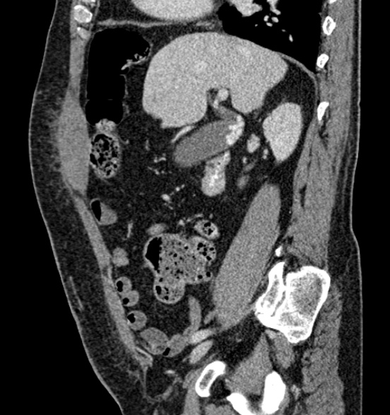 Bilateral rectus sheath hematomas (Radiopaedia 50778-56252 B 30).jpg