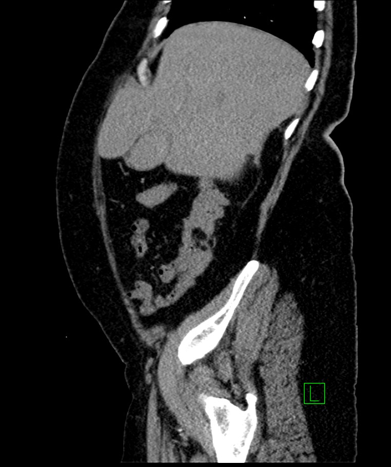 Bilateral sporadic synchronous clear cell renal cell carcinoma (Radiopaedia 85035-100575 E 98).jpg