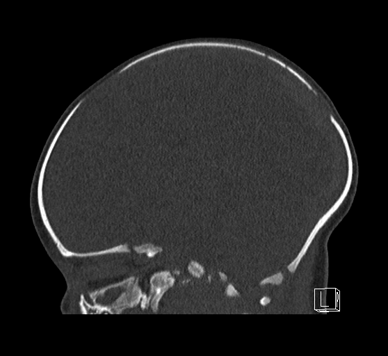 Bilateral subdural hemorrhage and parietal skull fracture (Radiopaedia 26058-26192 Sagittal bone window 40).png