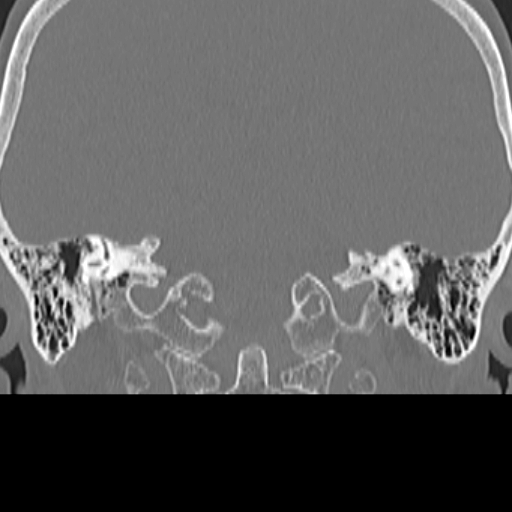 File:Bilateral tympanoplasty (Radiopaedia 16947-16664 Coronal bone window 19).jpg
