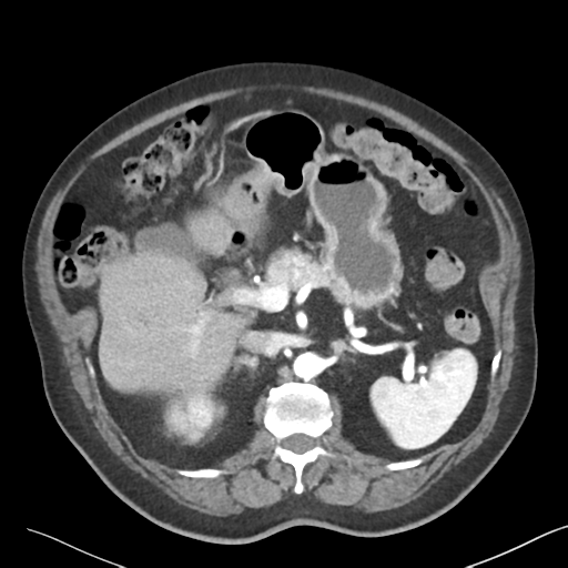 File:Bladder papillary urothelial carcinoma (Radiopaedia 48119-52951 A 14).png