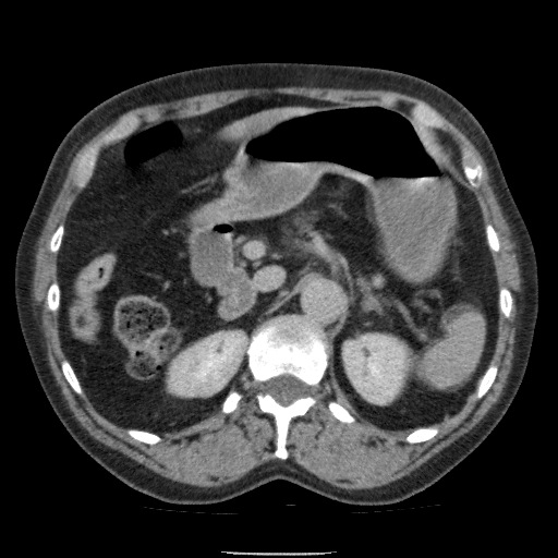 Bladder tumor detected on trauma CT (Radiopaedia 51809-57609 C 42).jpg