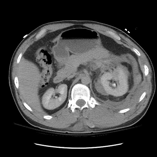 File:Blunt abdominal trauma with solid organ and musculoskelatal injury with active extravasation (Radiopaedia 68364-77895 Axial C+ delayed 45).jpg
