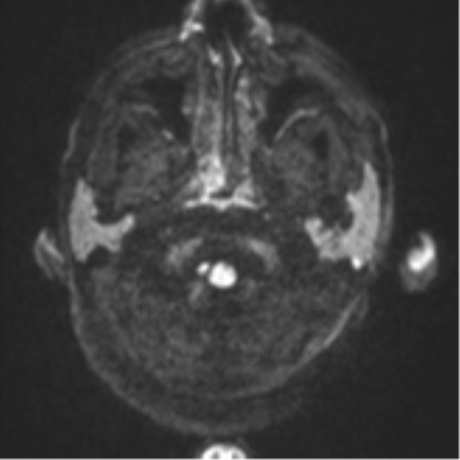 Blunt cerebrovascular injury (Radiopaedia 53682-59745 Axial DWI 33).png