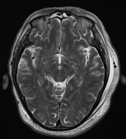 File:Blunt cerebrovascular injury (Radiopaedia 53682-59745 Axial T2 14).png