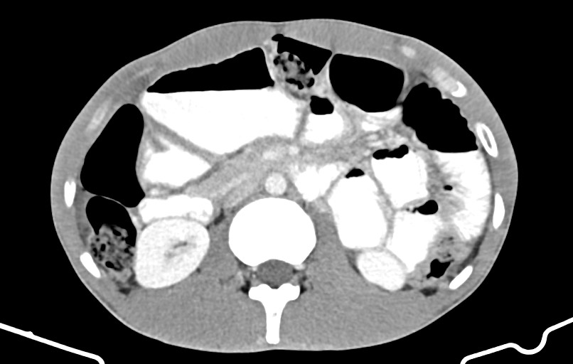 Blunt injury to the small bowel (Radiopaedia 74953-85987 A 68).jpg