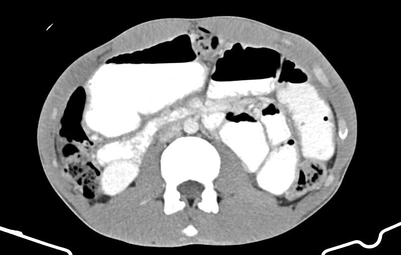 Blunt injury to the small bowel (Radiopaedia 74953-85987 A 76).jpg
