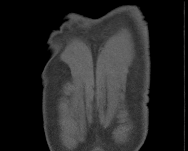 File:Boerhaave syndrome (Radiopaedia 39382-41660 C 89).png