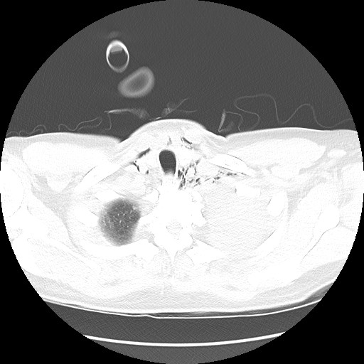 Boerhaave syndrome (Radiopaedia 59796-67310 Axial lung window 10).jpg