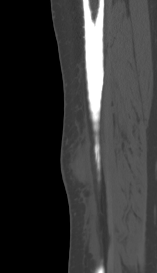 Bone metastasis - tibia (Radiopaedia 57665-64609 Sagittal bone window 37).jpg
