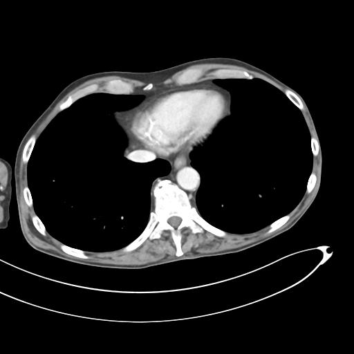 Bone metastasis from squamous cell carcinoma (Radiopaedia 30133-30730 B 7).jpg