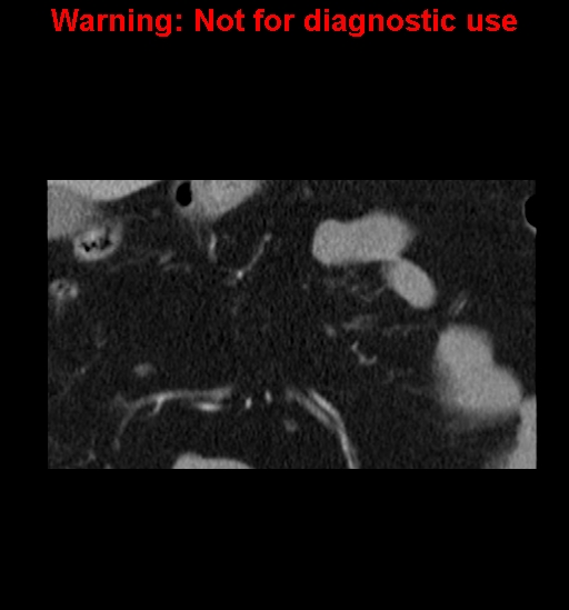 File:Bosniak renal cyst - type IV (Radiopaedia 23402-23466 C 9).jpg