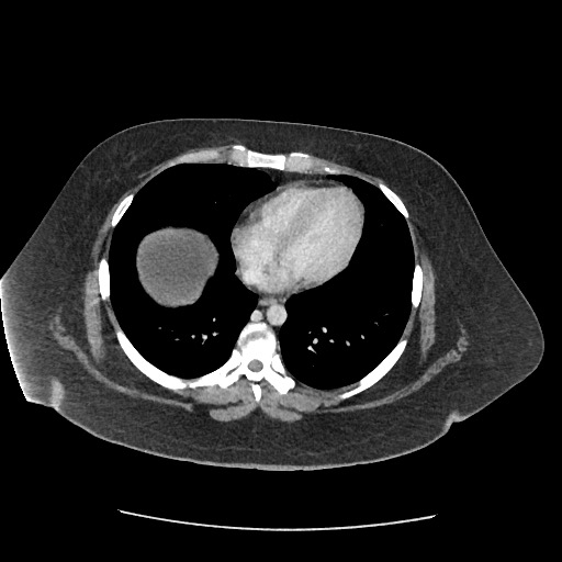 Bowel and splenic infarcts in acute lymphocytic leukemia (Radiopaedia 61055-68915 A 12).jpg