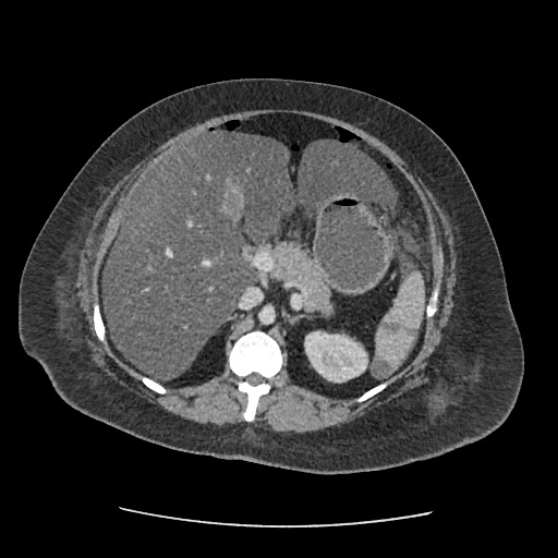 Bowel and splenic infarcts in acute lymphocytic leukemia (Radiopaedia 61055-68915 A 51).jpg